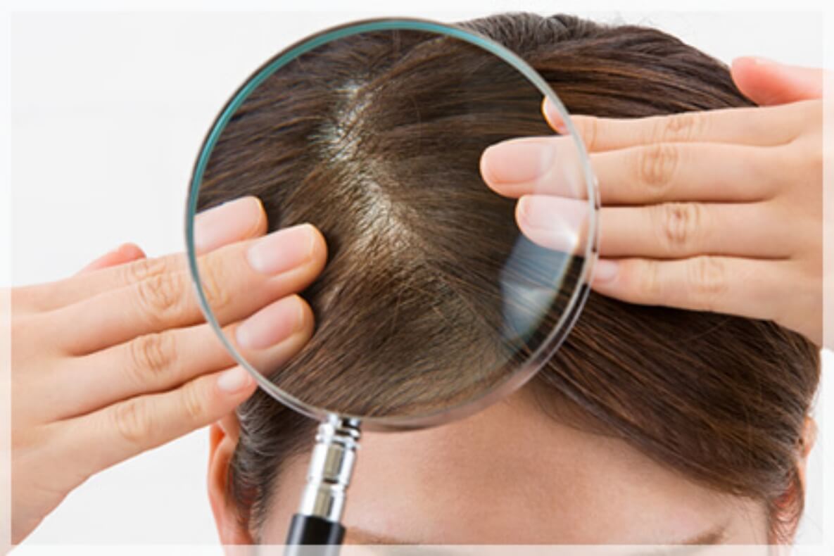 FAGA（女性男性型脱毛症）ってどんな脱毛症？脱毛パターンや治療の流れを紹介