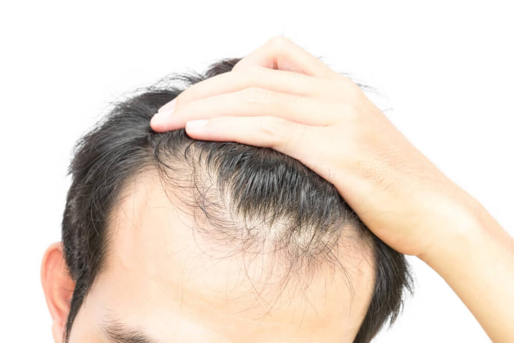 【医師監修】プロペシアでは初期脱毛は起こらない！抜け毛が減らない原因とは？