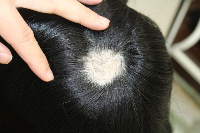 眉毛の抜け毛予防